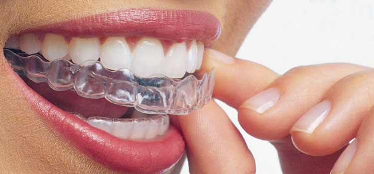 Ortodoncia sin brackets: ¿Qué es Keep Smiling?