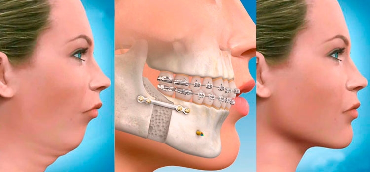 Ortodoncia y Cirugía ortognática